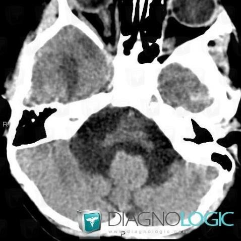 Choroid plexus papilloma, Posterior fossa, CT