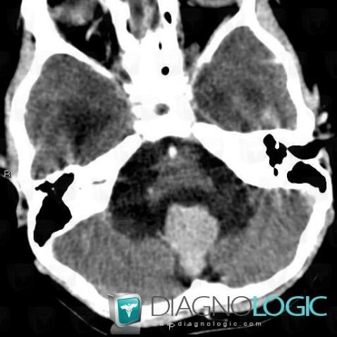 Choroid plexus papilloma, V4 and vermis, Posterior fossa, CT