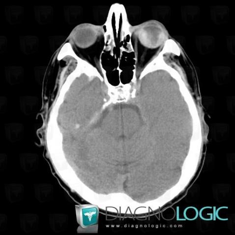 Choroidal detachment, Eye, CT