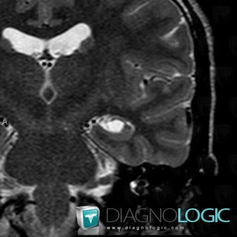 Choroidal fissure cyst, Cerebral hemispheres, MRI