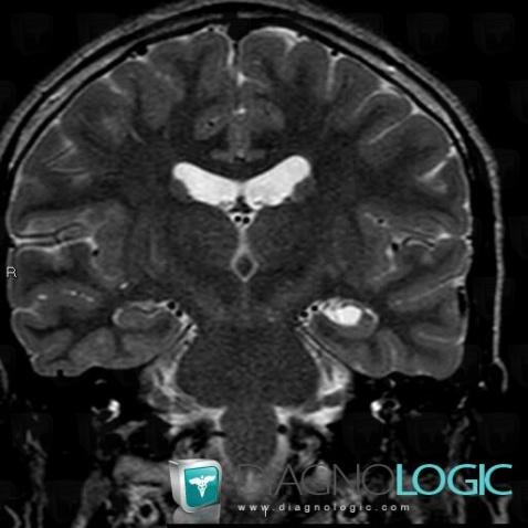 Choroidal fissure cyst, Cerebral hemispheres, Ventricles / Periventricular region, MRI