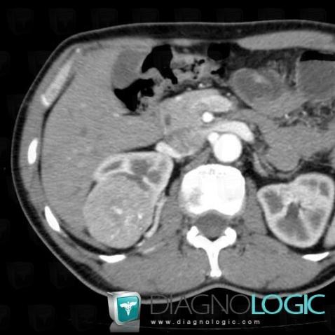 Chromophobic cell type renal cell carcinoma, Kidney, CT