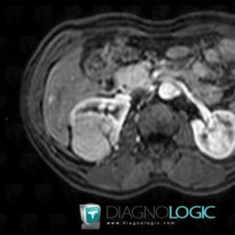 Chromophobic cell type renal cell carcinoma, Kidney, MRI