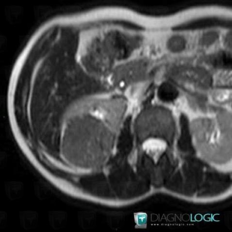 Chromophobic cell type renal cell carcinoma, Kidney, MRI