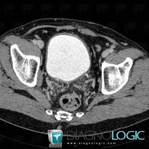 Chronic bladder outlet obstruction, Urinary bladder, CT