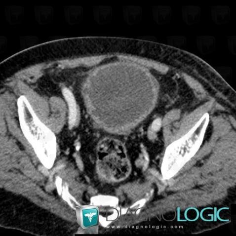 Chronic bladder outlet obstruction, Urinary bladder, CT