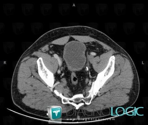 Chronic bladder outlet obstruction, Urinary bladder, CT