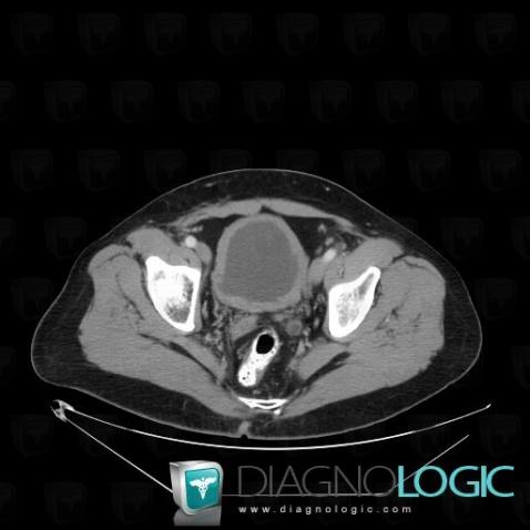 Chronic bladder outlet obstruction, Urinary bladder, CT