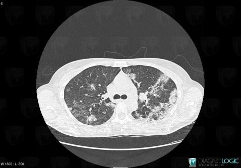 Chronic eosinophilic pneumonia, Pulmonary parenchyma, CT