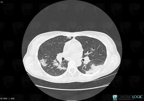 Chronic eosinophilic pneumonia, Pulmonary parenchyma, CT