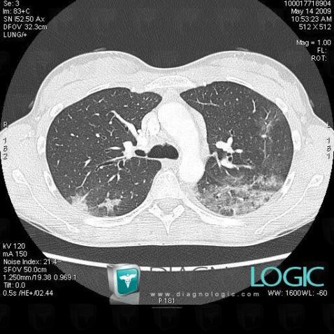 Chronic eosinophilic pneumonia, Pulmonary parenchyma, CT