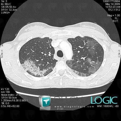 Chronic eosinophilic pneumonia, Pulmonary parenchyma, CT