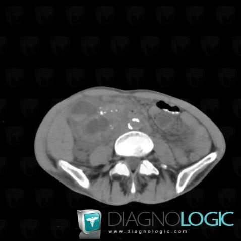 Chronic pancreatitis, Pancreas, CT