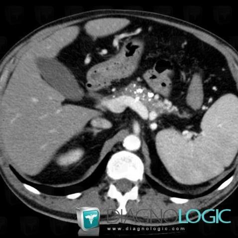 Chronic pancreatitis, Pancreas, CT