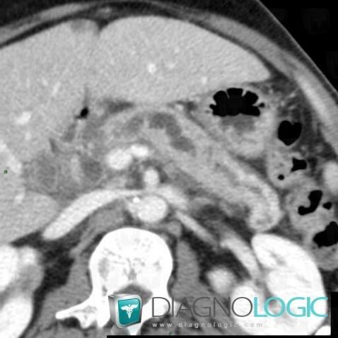 Chronic pancreatitis, Pancreas, CT