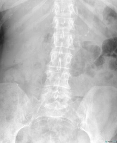 Chronic pancreatitis, Pancreas, X rays