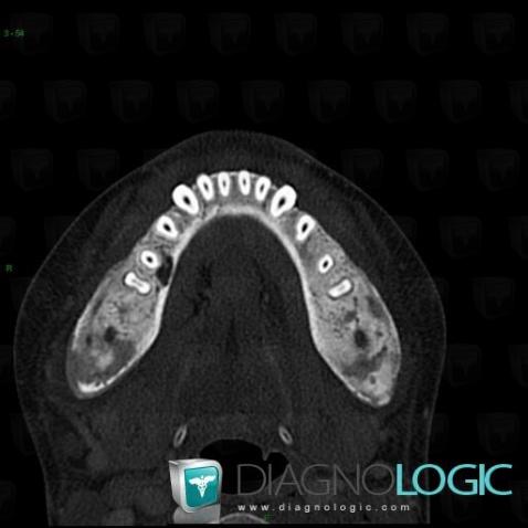 Chronic Recurrent Multifocal Osteomyelitis, Mandible, CT