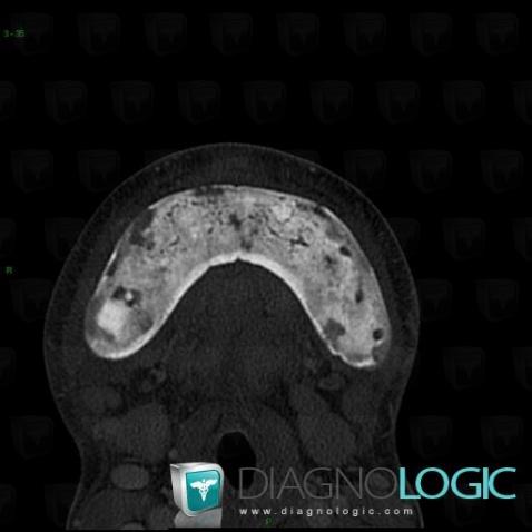 Chronic Recurrent Multifocal Osteomyelitis, Mandible, CT