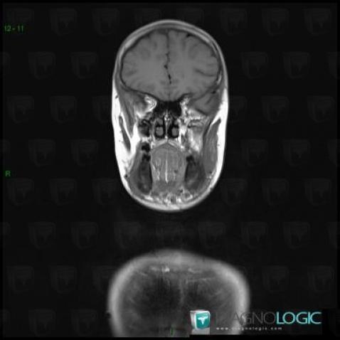 Chronic Recurrent Multifocal Osteomyelitis, Mandible, MRI