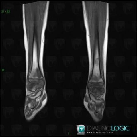 Chronic Recurrent Multifocal Osteomyelitis, Tibia - Distal part, Talus, MRI