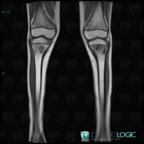 Chronic Recurrent Multifocal Osteomyelitis, Tibia - Proximal part, MRI