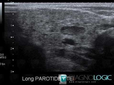 Chronic recurrent sialadenitis, Parotid and other salivary glands, US