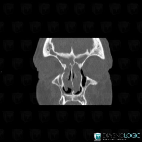 Churg-strauss syndrome, Nasal cavity / Nasopharynx, CT