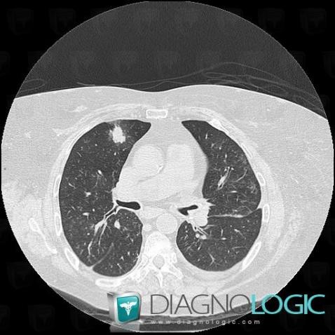 Churg-strauss syndrome, Pulmonary parenchyma, CT