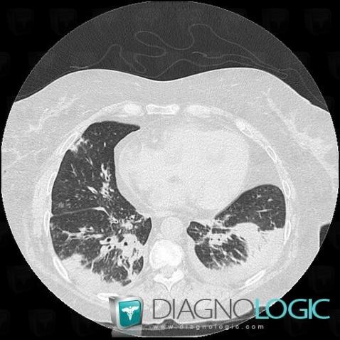 Churg-strauss syndrome, Pulmonary parenchyma, CT