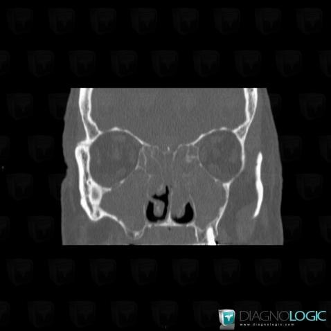 Churg-strauss syndrome, Sinus, CT