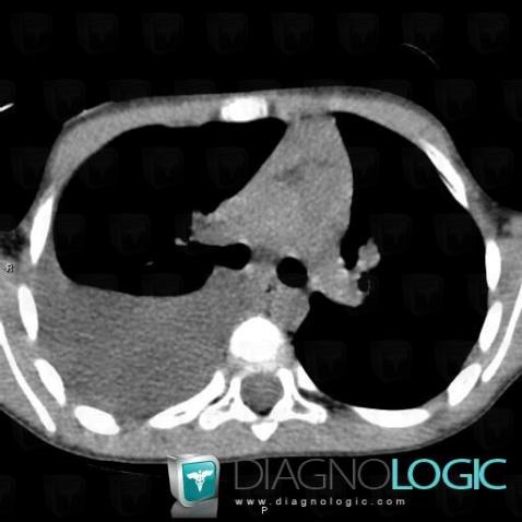 Cas radiologie : Chylothorax (Scanner) - Diagnologic