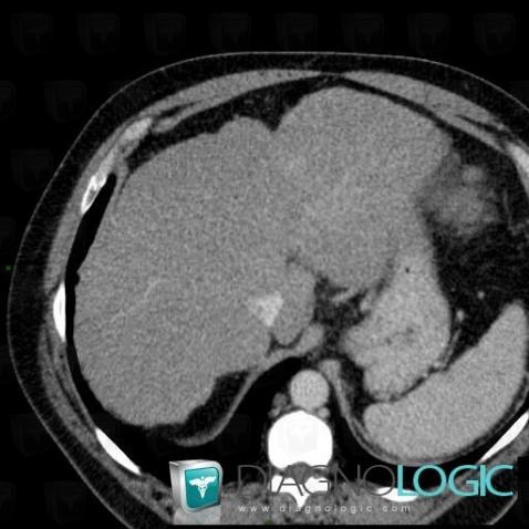 Cirrhosis, Liver, CT