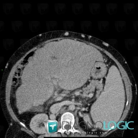 Cirrhosis, Liver, Spleen, CT