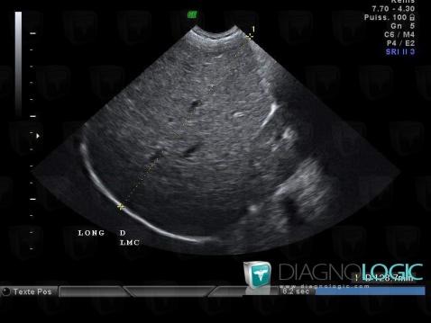 Cirrhosis, Liver, US