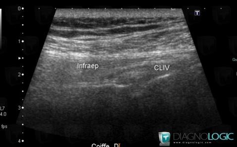 Clivage intra-tendineux / Epaule, Tendon infra épineux, Echographie