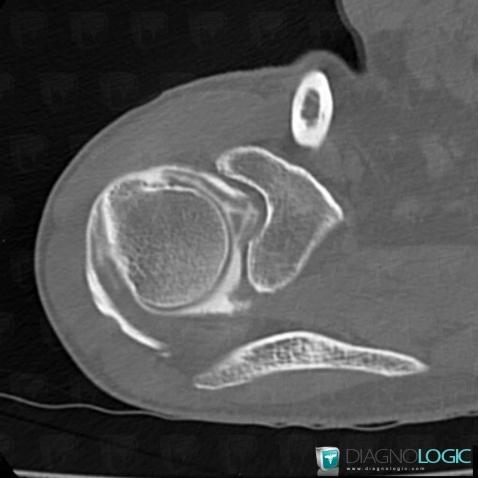 Clivage intra-tendineux / Epaule, Tendon infra épineux, Scanner