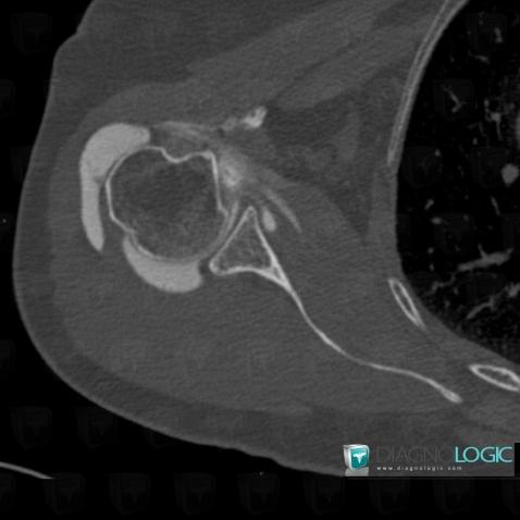 Clivage intra-tendineux / Epaule, Tendon sub scapulaire, Scanner