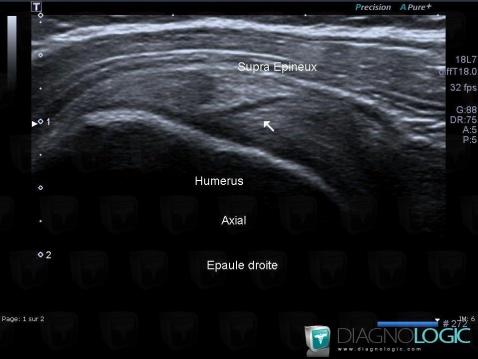 Clivage intra-tendineux / Epaule, Tendon supra épineux, Echographie