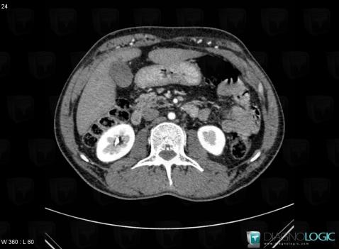 Coarctation-aorta, Abdominal aorta, CT