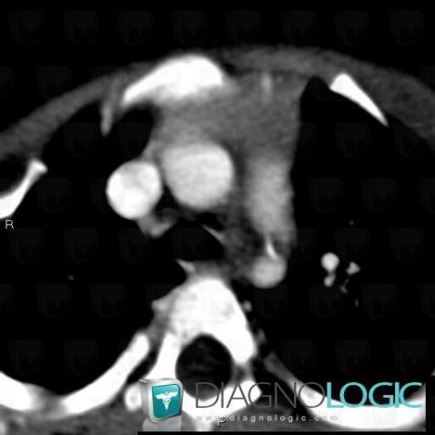 Coarctation-aorta, Aorta, CT