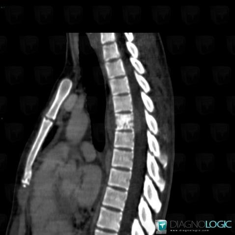 Coccidioidomycosis, Vertebral body / Disk, CT