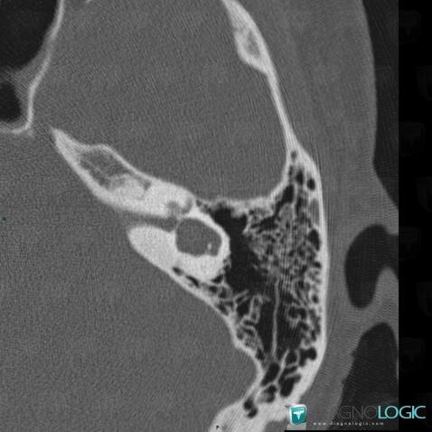 Cochlear dysplasia, Inner ear, CT