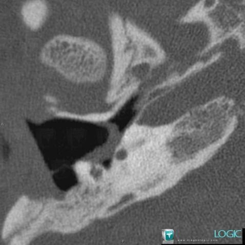 Cochlear dysplasia, Inner ear, CT