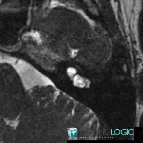 Cochlear dysplasia, Inner ear, MRI