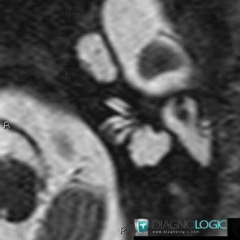 Cochlear dysplasia, Inner ear, MRI