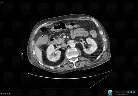 Colite infectieuse, Colon, Scanner