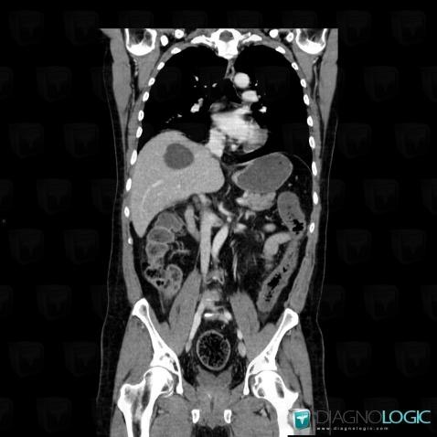 Colite ischémique , Colon, Scanner