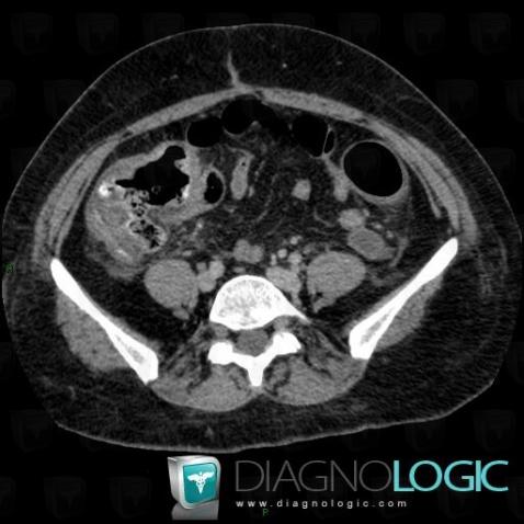 Colite pseudomembraneuse , Colon, Scanner