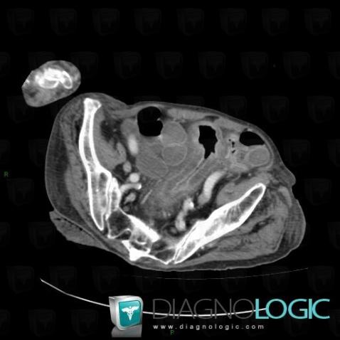 Colite pseudomembraneuse , Colon, Scanner