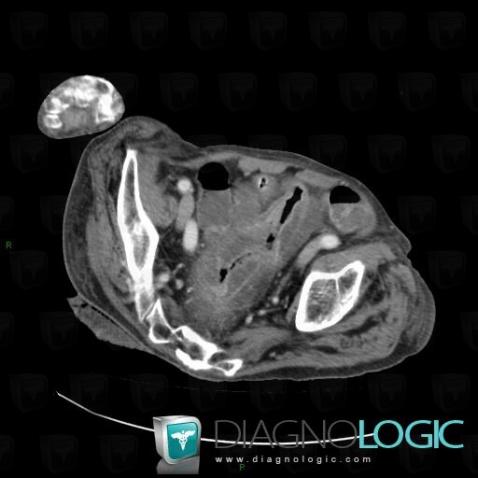 Colite pseudomembraneuse , Colon, Scanner